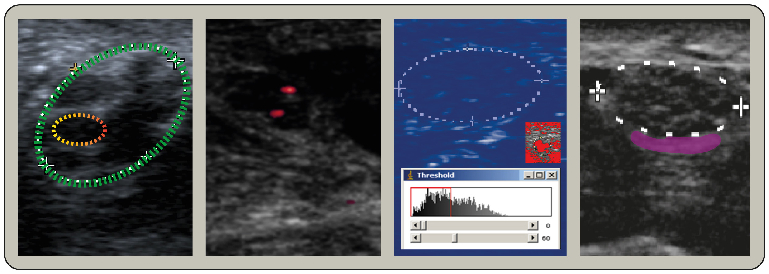Basis technieken – Metingen Zenuwechografie | NVKNF